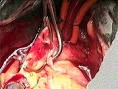 Hazards of an Unhealthy Lifestyle, Cirrhosis, Lung Disease, Heart ...