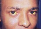 symptom of <b>hepatitis</b>,