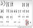 Klinefelter Syndrome