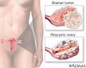 Overproductive ovaries: MedlinePlus Medical Encyclopedia Image