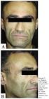 the zygomatic major muscle