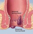 Colorado Painless Hemorrhoid Treatment - Mountain Streams Medical ...