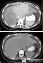 LearningRadiology - Budd-Chiari Syndrome