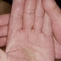 Fungal Skin Infection | Fungal Infections Of The Skin | Skin ... 
