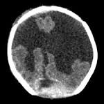 <b>Dandy</b>-<b>Walker syndrome</b>