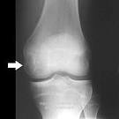 <b>Chondroblastoma</b> | BONETUMOR.