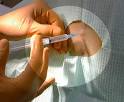 Anesthesia Can Affect Learning Abilities, Says Study | TopNews ...