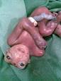 ANENCEPHALY - Wikipedia, the free encyclopedia