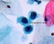 Dysplasia - Wikipedia, the free encyclopedia