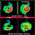 <b>Ischémie myocardique</b>