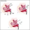 Dilatation and Curettage - procedure, blood, tube, removal ...