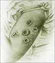who had contracted <b>cowpox</b>.