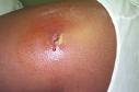 Skin Abscess Treatment, Symptoms, Home Remedies for Boils and ...