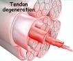 Achilles Tendon Problems | Atlanta Sports Medicine