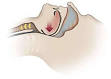 <b>Syndrome d</b>'<b>Apnée Obstructive</b>