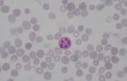 marcada <b>pancitopenia</b> tras