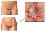 HPV às <b>doenças</b> neoplásicas