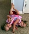 Conjoined twins reunited after surgery goes awry / Scrape TV - The ...