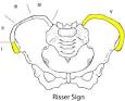 Accelerated Bone Maturation in Children