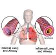 Acute Bronchitis In Children - Care Guide