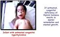<b>Congenital hypothyroidism</b>