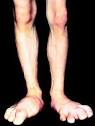 HGH Side effects: Find out how misuse of HGH can be very harmful ...