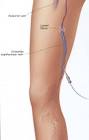 Endovenous Laser Treatment of Varicose Veins (EVLT) - Medrehab
