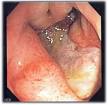 Peptic ulcer - Wikipedia, the free encyclopedia