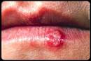 Cold Sores (Fever Blisters) Picture Image on MedicineNet.