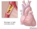 Coronary thrombosis