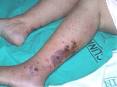 Existe alguna <b>Porfiria</b> en la
