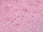 How vitamin D may help clear amyloid plaques found in Alzheimer's ...