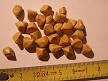 Study: Gallstones, cholecystectomy and irritable bowel syndrome ...