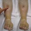 "Pitting" <b>edema</b>