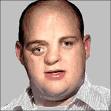 Birth defects