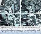 Ectopic <b>pituitary adenoma</b> is