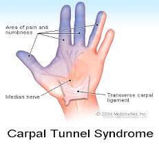  Avoid Carpal Tunnel Surgery   Stop the Pain Now!