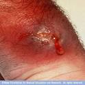 Multiple recurring boils in my buttocks, neck – sign of hiv or ...