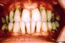 Oppza Health Care: Some Dental and <b>Periodontal Diseases</b>