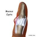 Mucous Cysts of the Fingers - Orthogate