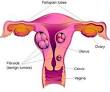 random thoughts...: Understanding <b>Myoma</b>