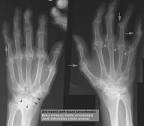 <b>Rheumatoid Arthritis</b>