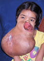 Girl to have Surgery to Remove