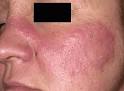 Dermatomyositis - symptoms, causes, diagnosis and treatment by ...