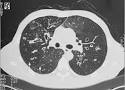 Morning Report: How Do You Approach a Patient With Bronchiectasis ...