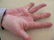 <b>Dupuytren's contracture</b> of the