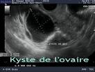 <b>Kyste</b> de <b>l</b>'<b>ovaire</b> Dr SKHIRI
