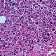 What is an Eosinophilic Disorder? | Cincinnati Center for ...