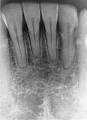 Apical <b>root resorption</b>.