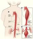 Disease of the Aorta   PVD   cardiovascular disease   Heart